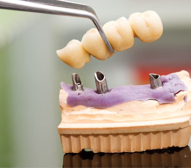 Dental Bridges, inHarmony Dental Care