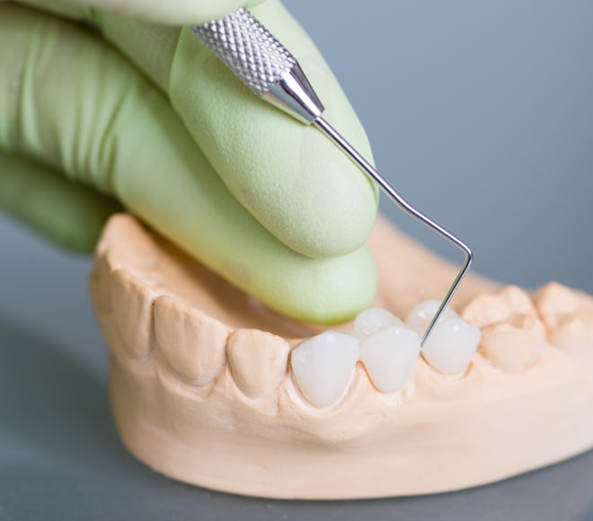 Dental onlays at inHarmony Dental Care