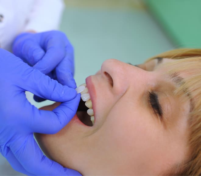 Dental veneers at inHarmony Dental Care